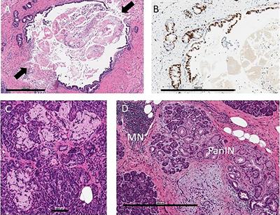 Substance Use Affects Type 1 Diabetes Pancreas Pathology: Implications for Future Studies